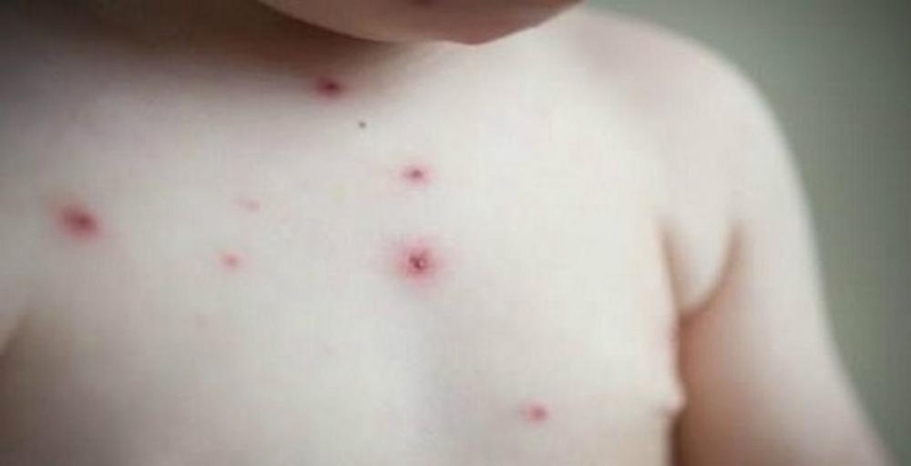 Em 2023, Feira de Santana já registrou mais de 150 casos de catapora