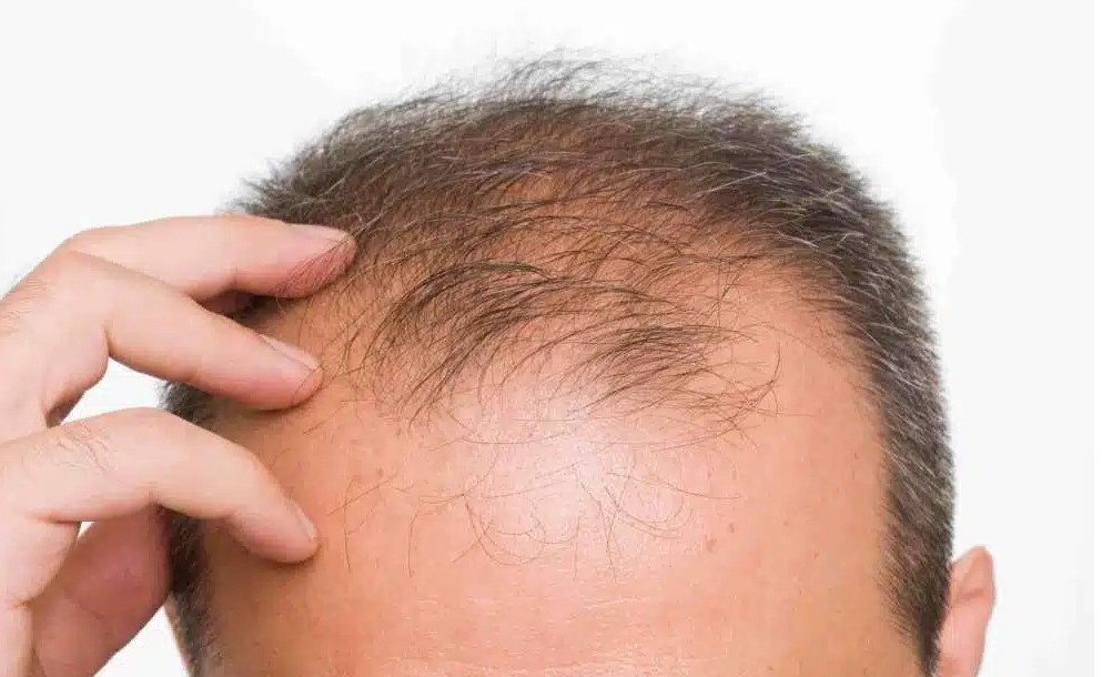 Novo remédio contra queda de cabelo é aprovado pela Anvisa