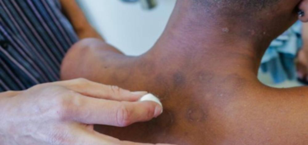 Ministério da Saúde investirá R$ 55 mi para ações de combate a hanseníase