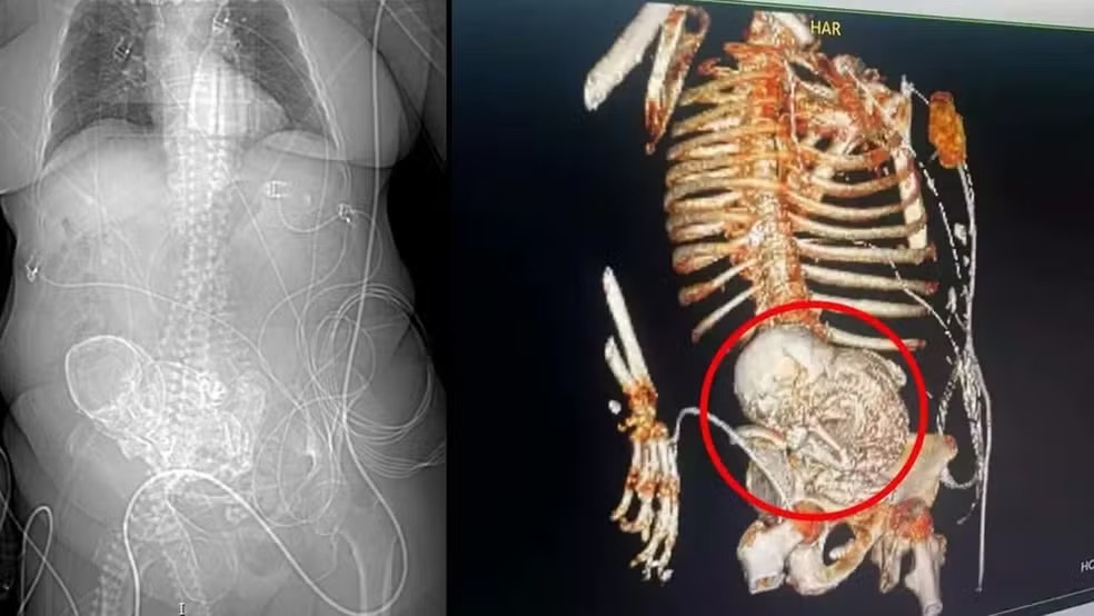 Idosa de 81 anos descobre feto calcificado que carregou por mais de 5 décadas