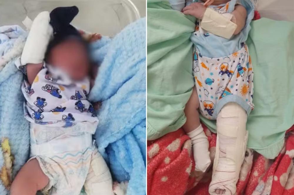 Bebê tem fêmur fraturado durante parto em maternidade de Camaçari
