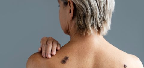 Entre os diversos tipos de câncer, o de pele é o mais incidente no Brasil