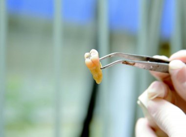 Professor condena tráfico de dentes em Feira de Santana; estudantes e docentes legitimam crime